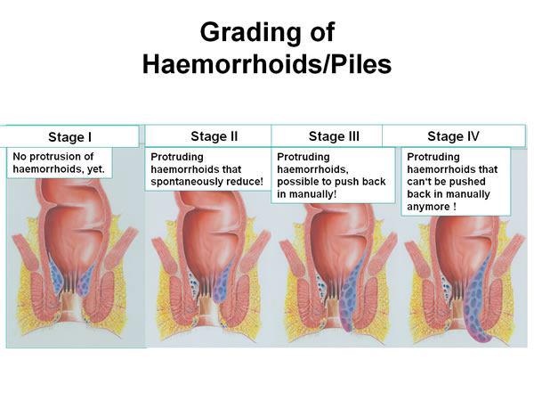 Gambar artikel apa itu ambeien?